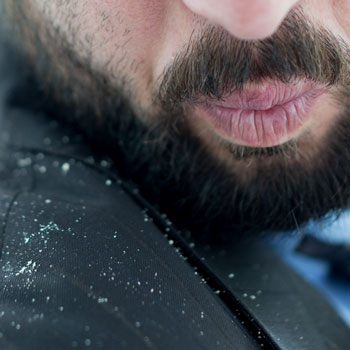 Man With Beard & Dandruff On Shoulders