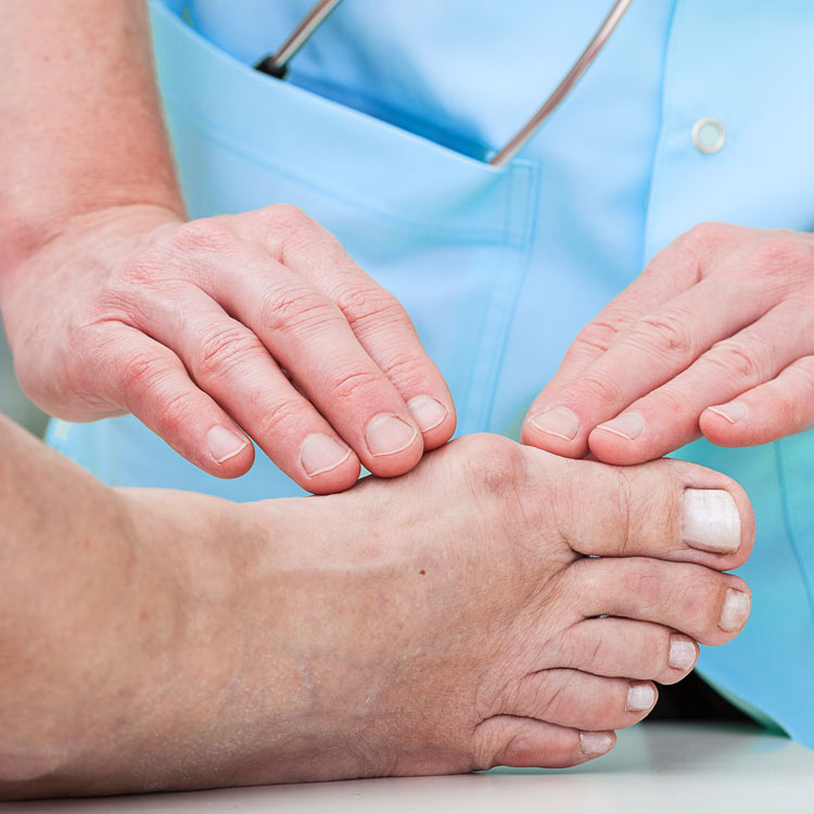 Physician Checking Foot Bunion