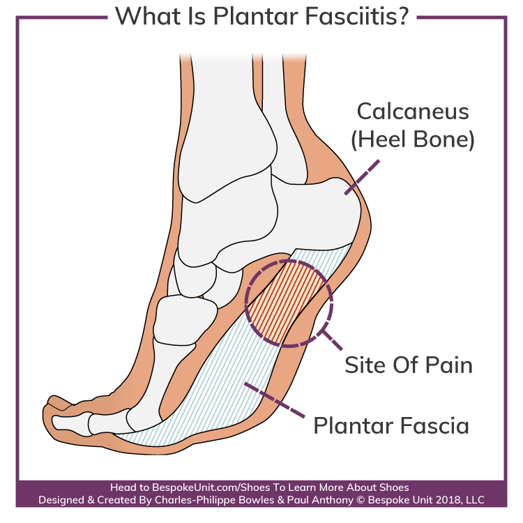 What Is Plantar Fasciitis