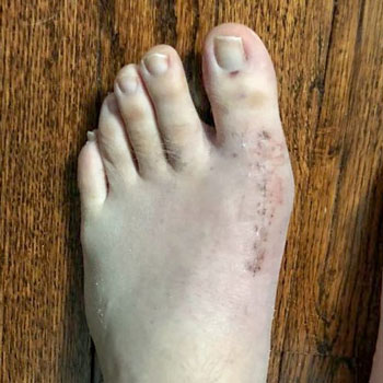 Post-Operation Bunion Foot