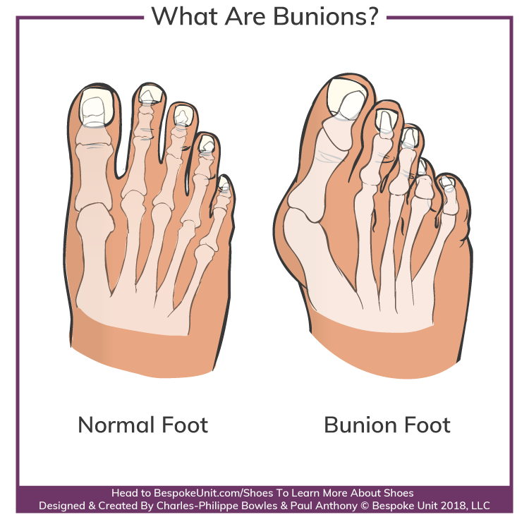 What Are Hallux Valgus Bunions
