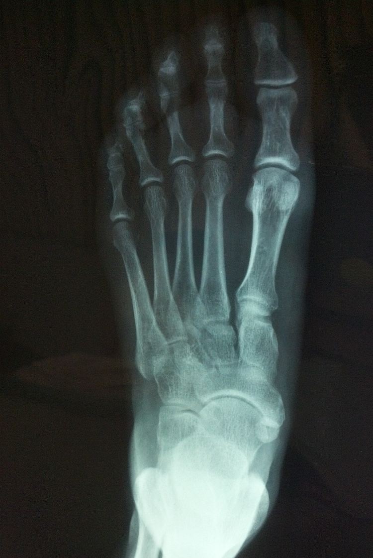 X-Ray Of Foot Plantar Fascia